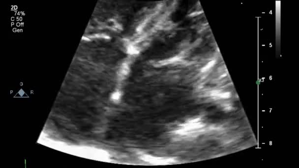 Ecografía Examen Transesofágico Del Corazón — Vídeos de Stock