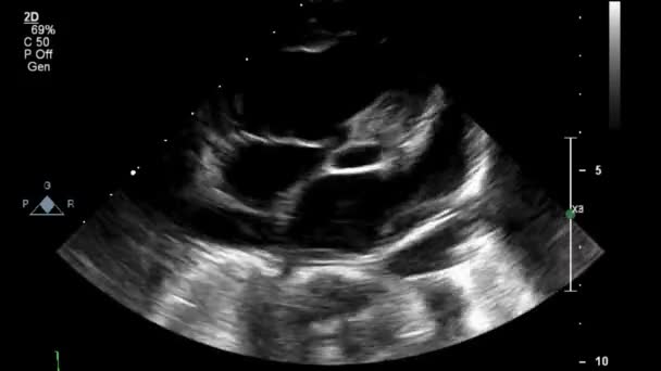 Ultrasound Transesophageal Examination Heart — Stock Video