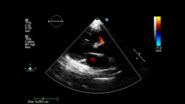 Beeld Van Het Hart Tijdens Transesofageale Echografie Met Doppler Modus — Stockfoto