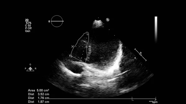 Transesofageal Ultrason Sırasında Kalbin Gri Ölçekli Görüntüsü — Stok fotoğraf