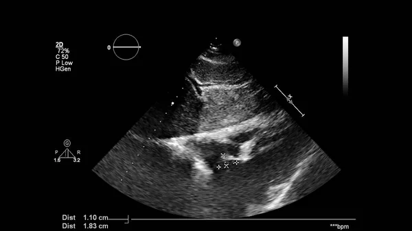 Transesofageal Ultrason Sırasında Kalbin Gri Ölçekli Görüntüsü — Stok fotoğraf