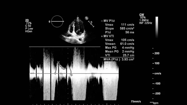 Image Cœur Mode Gris Lors Une Échographie Transœsophagienne — Photo