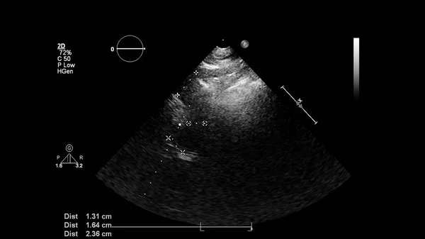 Image Heart Gray Scale Mode Transesophageal Ultrasound — Stock Photo, Image