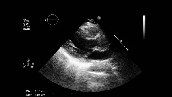Изображение Сердца Сером Режиме Время Трансофагеального Ультразвука — стоковое фото