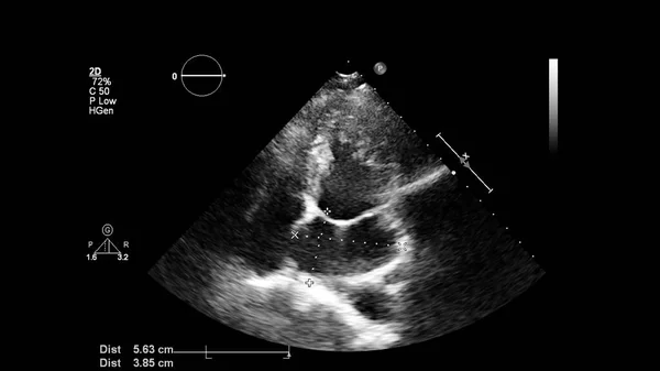 経食道超音波検査時のグレースケールモードで心臓の画像 — ストック写真