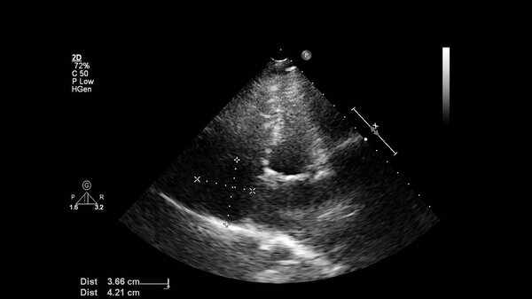 Image of the heart in gray-scale mode during transesophageal ultrasound.