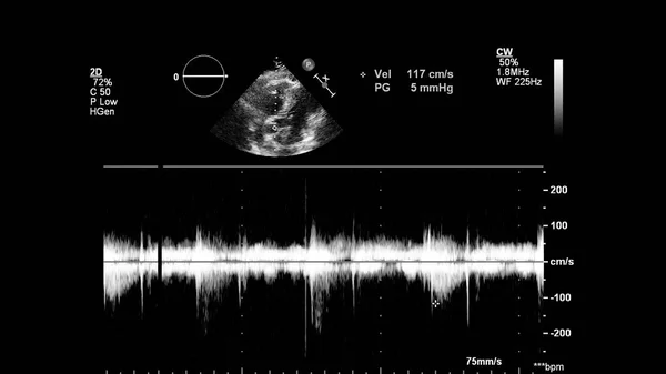 Transesofageal Ultrason Sırasında Kalbin Gri Ölçekli Görüntüsü — Stok fotoğraf