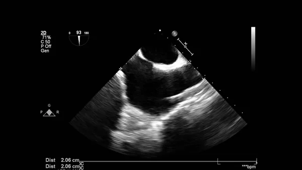 経食道超音波検査時のグレースケールモードで心臓の画像 — ストック写真