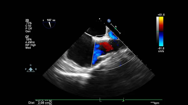 Immagine Del Cuore Durante Ecografia Transesofagea Con Modalità Doppler — Foto Stock