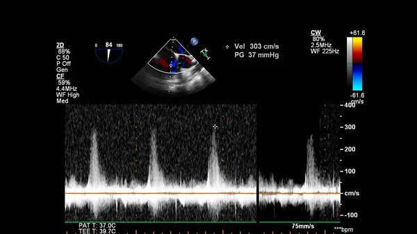 Transesofageal Ultrason Sırasında Doppler Kipi Ile Kalbin Görüntüsü — Stok fotoğraf