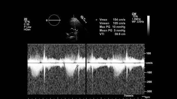 Image of the heart in gray-scale mode during transesophageal ultrasound.