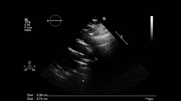 Afbeelding Van Het Hart Grijs Schaal Modus Tijdens Transesofageale Echografie — Stockfoto