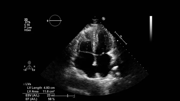 Bild Hjärtat Gråskala Transesofagalt Ultraljud — Stockfoto