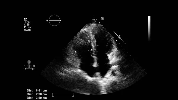 Transesofageal Ultrason Sırasında Kalbin Gri Ölçekli Görüntüsü — Stok fotoğraf