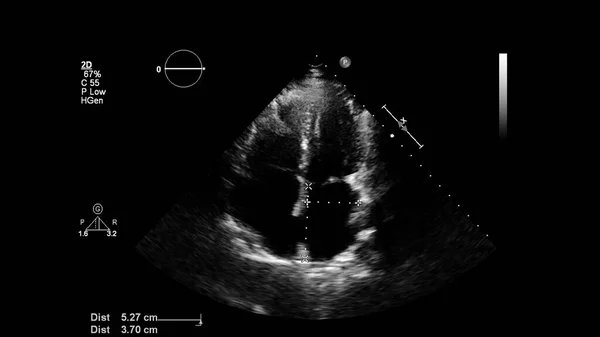 Image Heart Gray Scale Mode Transesophageal Ultrasound — Stock Photo, Image