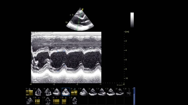 Image of the heart in gray-scale mode during transesophageal ultrasound.