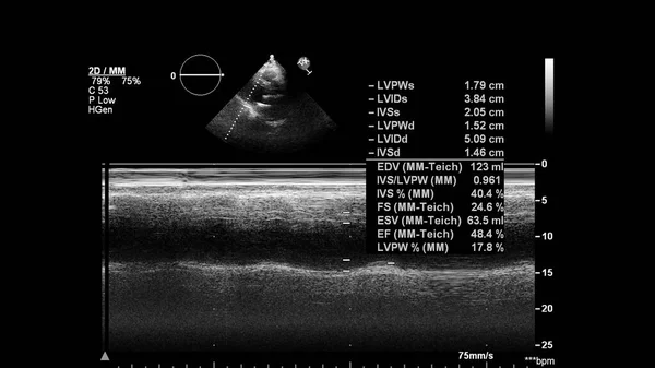 Kép Szív Szürke Skála Mód Során Transesophagealis Ultrahang — Stock Fotó