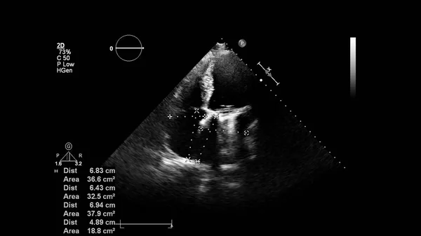 Image Cœur Mode Gris Lors Une Échographie Transœsophagienne — Photo