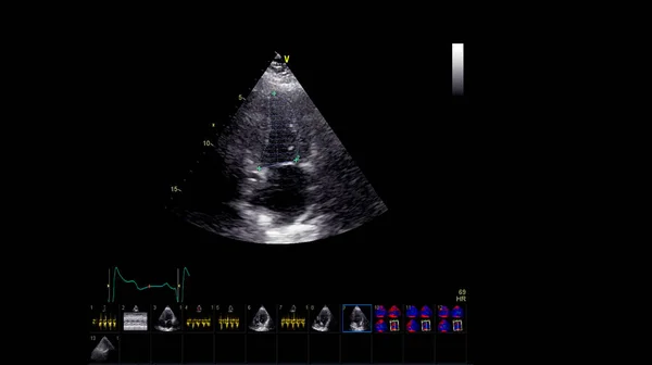 Image of the heart in gray-scale mode during transesophageal ultrasound.