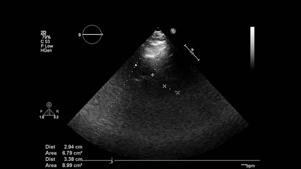 Afbeelding Van Het Hart Grijs Schaal Modus Tijdens Transesofageale Echografie — Stockfoto