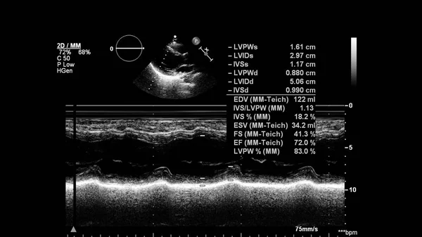 経食道超音波検査時のグレースケールモードで心臓の画像 ロイヤリティフリーのストック写真