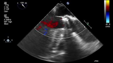 Kalbin ultrason transsofageal muayenesi.