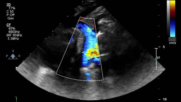 Ультразвуковое Трансофагеальное Исследование Сердца — стоковое видео