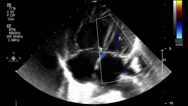 超声经食管检查心脏 — 图库视频影像