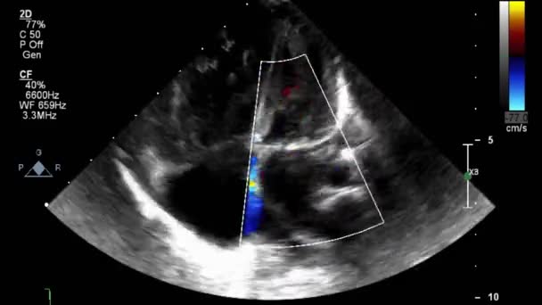 超声经食管检查心脏 — 图库视频影像