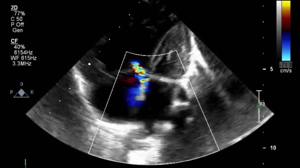 Echografie Transslokdarmonderzoek Van Het Hart — Stockvideo