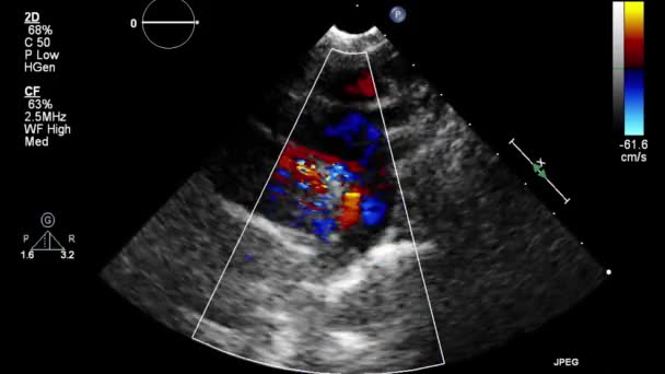 Ultrasound Transesophageal Pemeriksaan Jantung — Stok Video