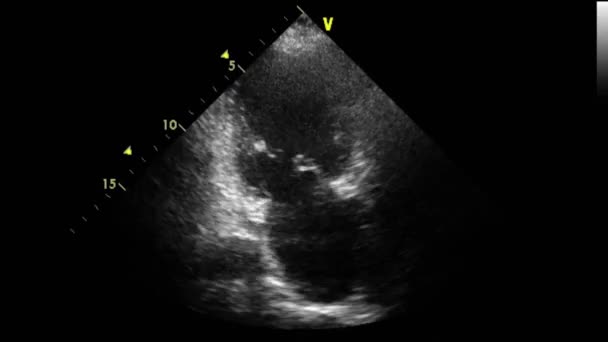 Ecografia Esame Transesofageo Del Cuore — Video Stock