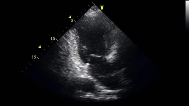 Echografie Transslokdarmonderzoek Van Het Hart — Stockvideo