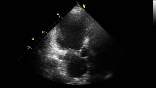 Ecografia Esame Transesofageo Del Cuore — Video Stock