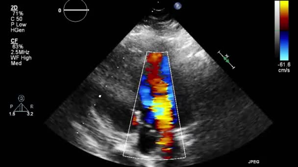 Ecografia Esame Transesofageo Del Cuore — Video Stock