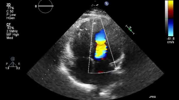 Ecografia Esame Transesofageo Del Cuore — Video Stock