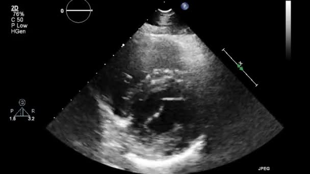 Echografie Transslokdarmonderzoek Van Het Hart — Stockvideo