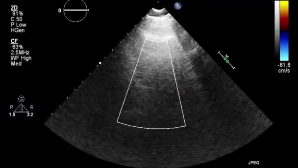 Ultraschall Transesophageale Untersuchung Des Herzens — Stockvideo