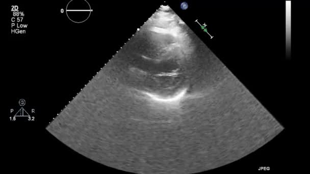 Ecografía Examen Transesofágico Del Corazón — Vídeo de stock