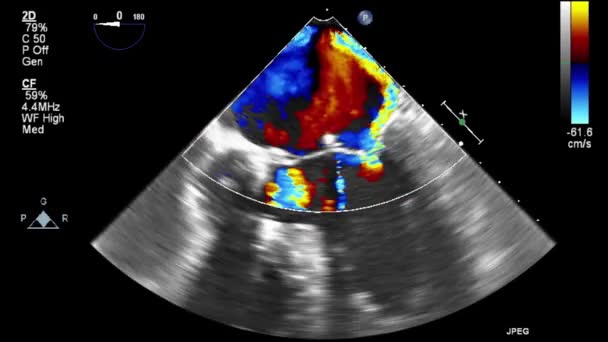 Echografie Transslokdarmonderzoek Van Het Hart — Stockvideo