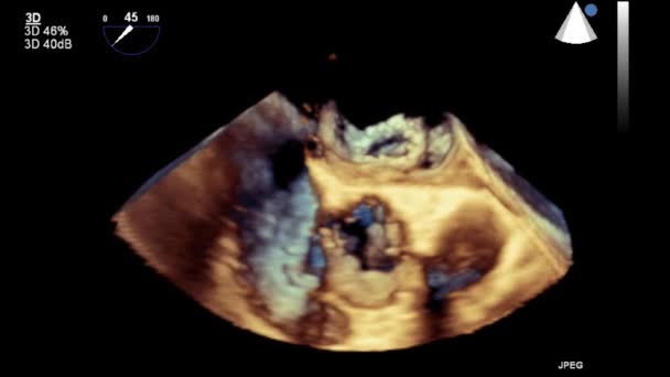 Ultrasound Transesophageal Pemeriksaan Jantung — Stok Video