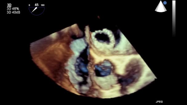 Ecografía Examen Transesofágico Del Corazón — Vídeos de Stock