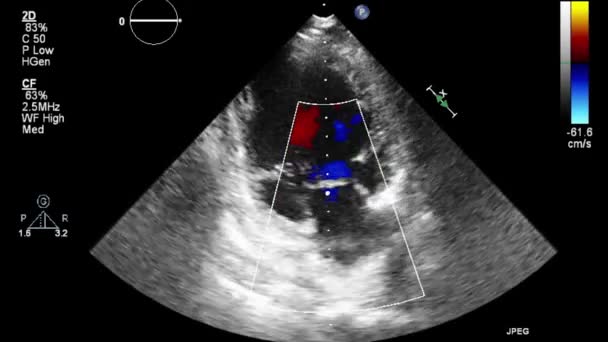 Ecografia Esame Transesofageo Del Cuore — Video Stock