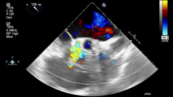 Ecografia Esame Transesofageo Del Cuore — Video Stock