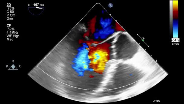 Ecografia Esame Transesofageo Del Cuore — Video Stock