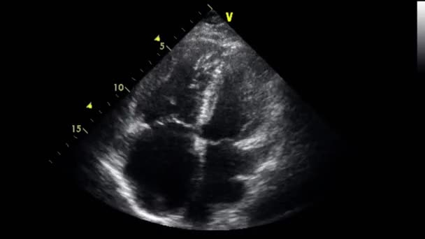 Exame Transesofágico Ultrassonográfico Coração — Vídeo de Stock