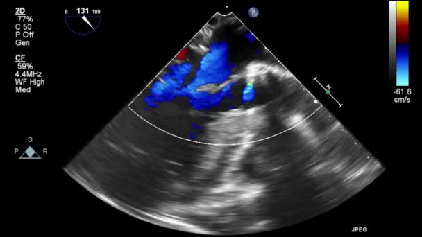 Ultraschall Transesophageale Untersuchung Des Herzens — Stockvideo