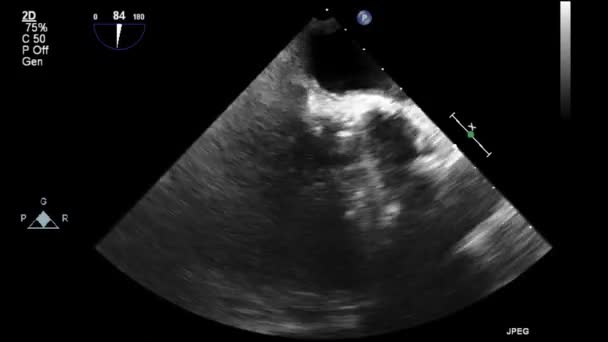 Ultrasound Transesophageal Examination Heart — Stock Video