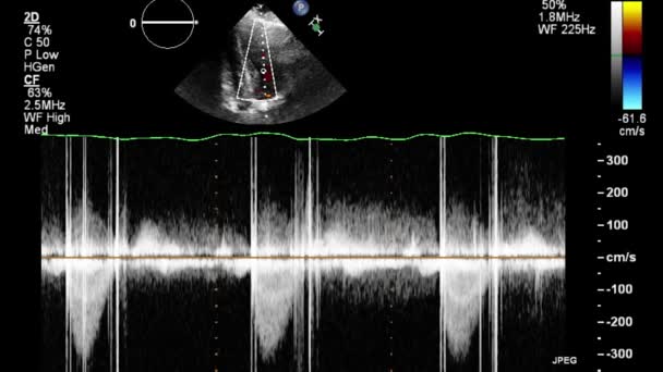 Ecografia Esame Transesofageo Del Cuore — Video Stock