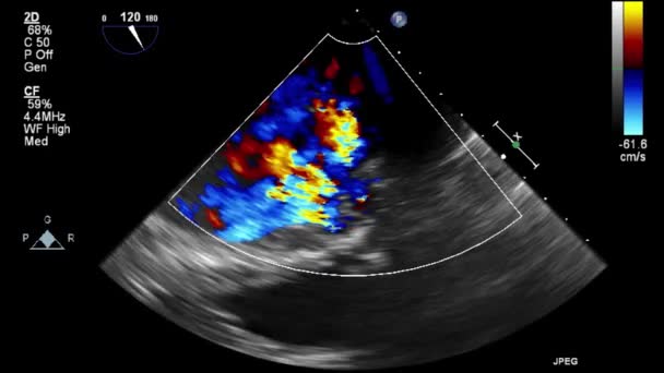 Ecografía Examen Transesofágico Del Corazón — Vídeos de Stock